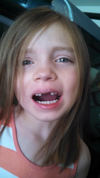 Goodbye Front Teeth