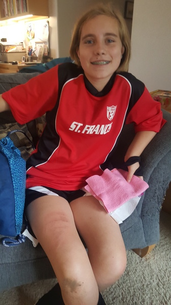 Soccer Injury