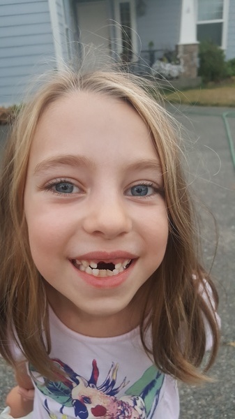 Lost Tooth
